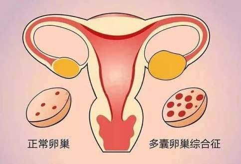 多囊性卵巢能做試管嬰兒嗎？多囊卵巢做試管面臨那些問題！