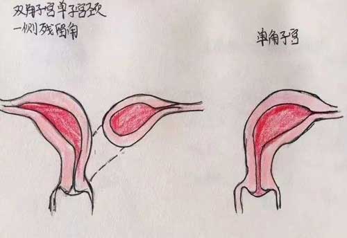 單角子宮可以試管嗎？試管嬰兒幫助更多人實現好孕！